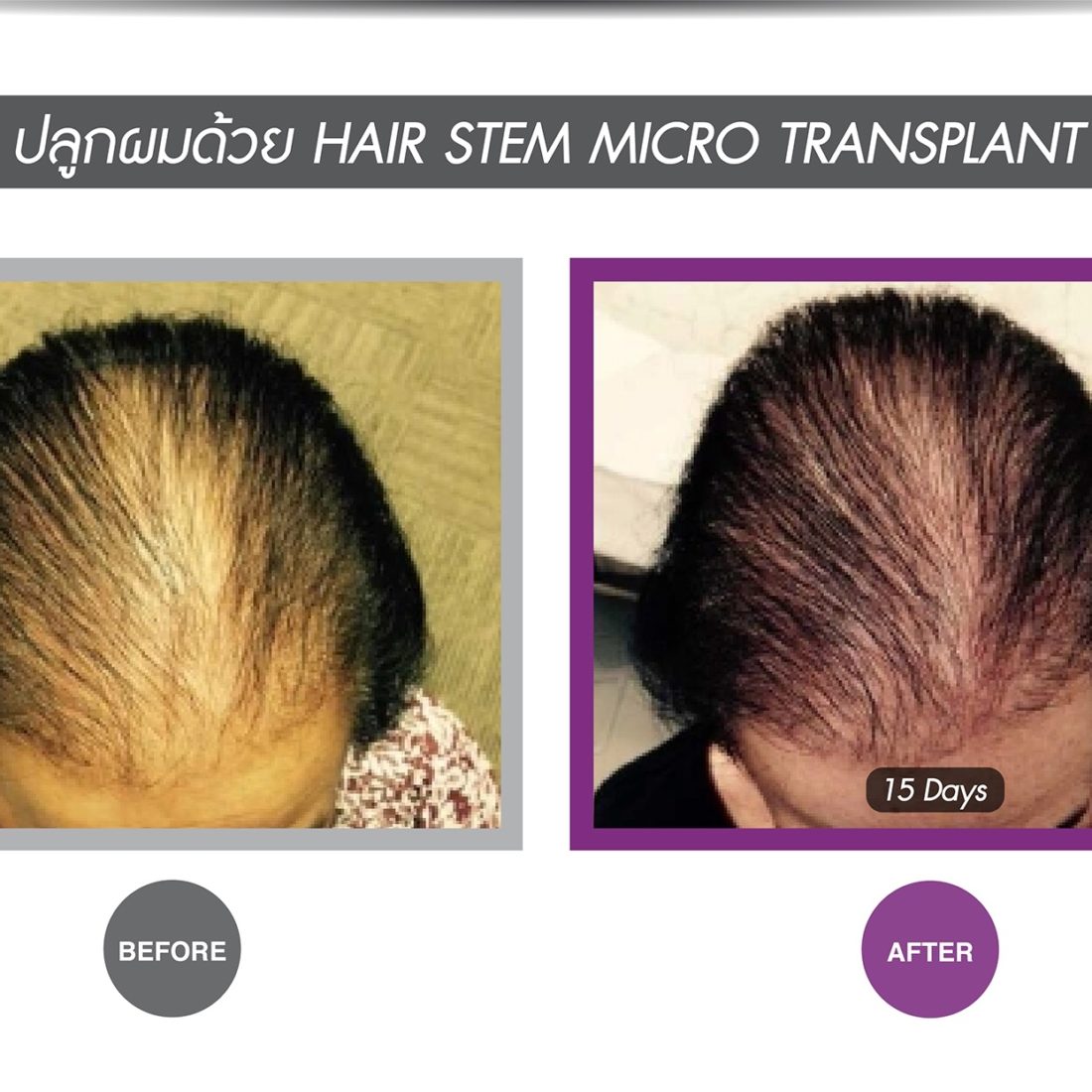 Hair Stem Cell Treatment for Hair Loss - Apex Medical Center