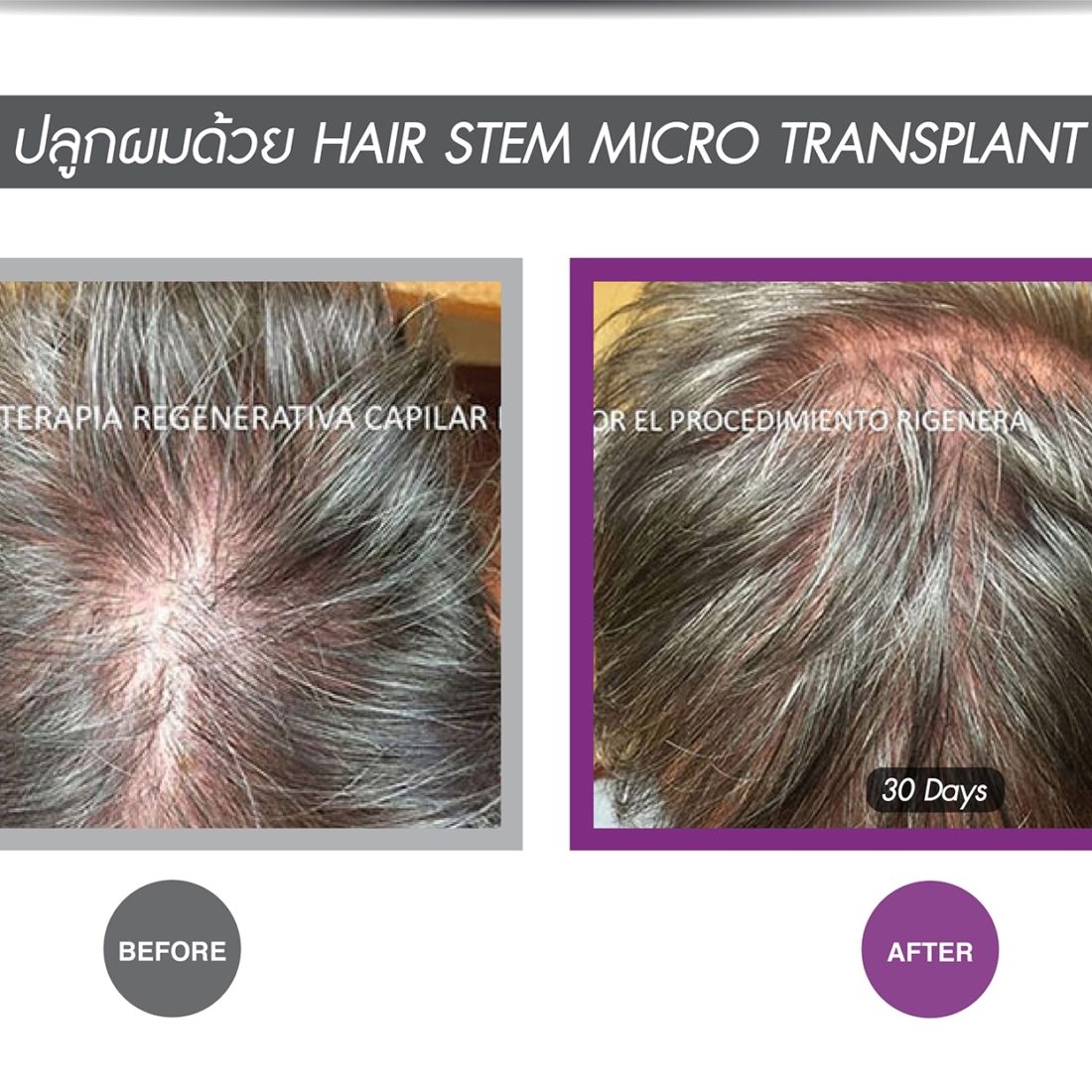 Hair Stem Cell Treatment for Hair Loss Apex Medical Center