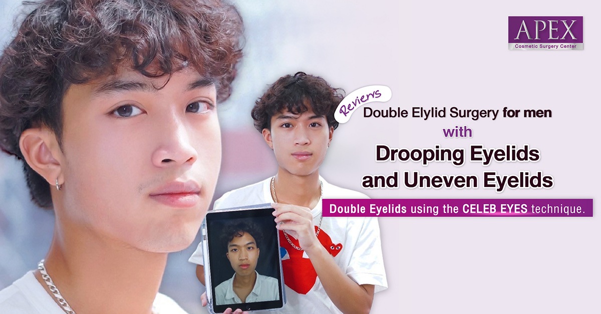 Review double eyelid surgery for men with drooping eyelids and uneven eyelids with double eyelids using the Celeb Eyes technique.