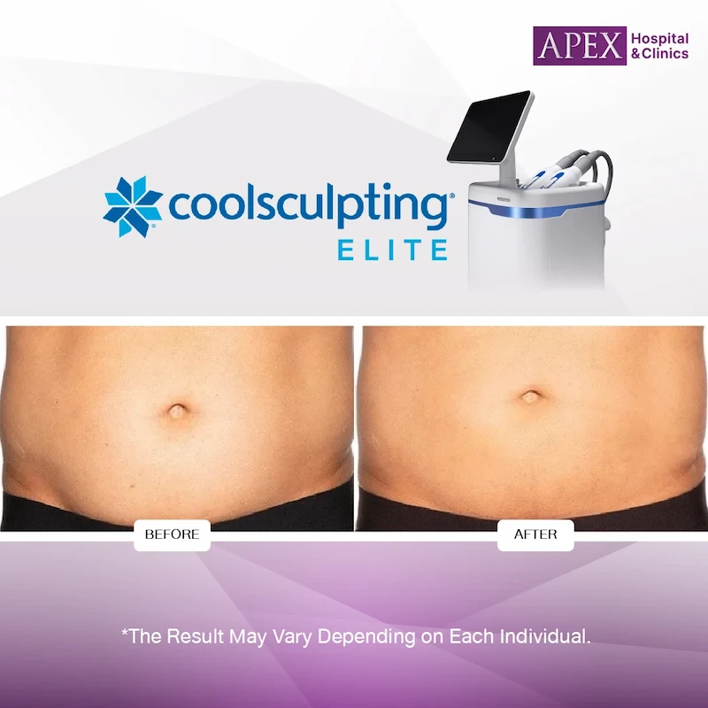 Coolsculpting Elite Review 04