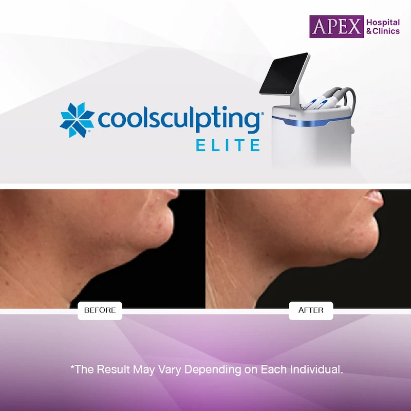 Coolsculpting Elite Review 02