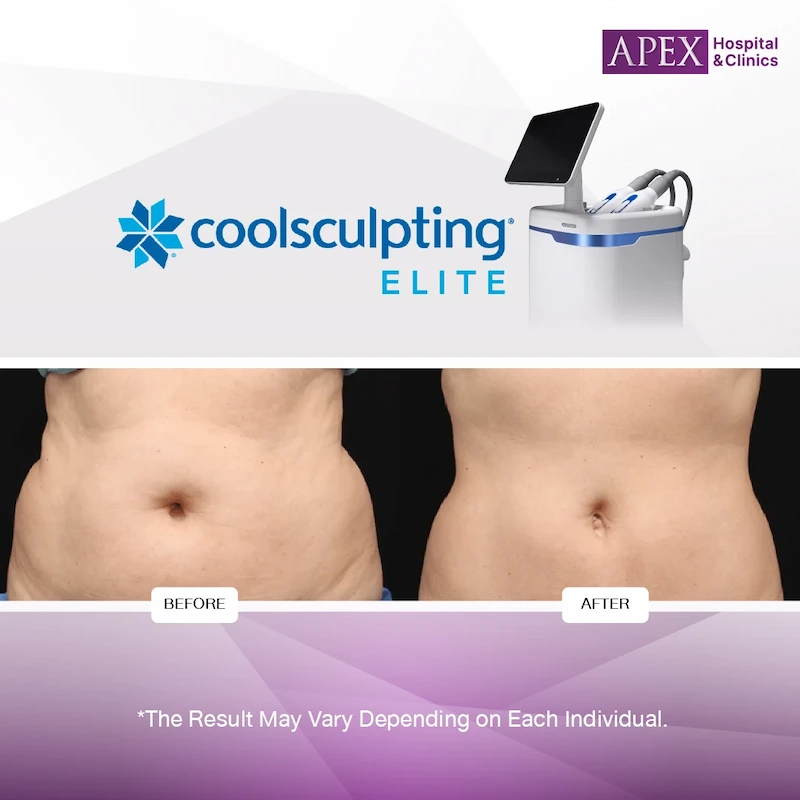 Coolsculpting Elite Review 03