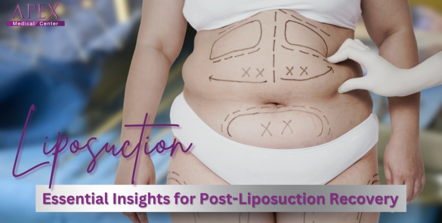 Essential Insights for Post-Liposuction Recovery