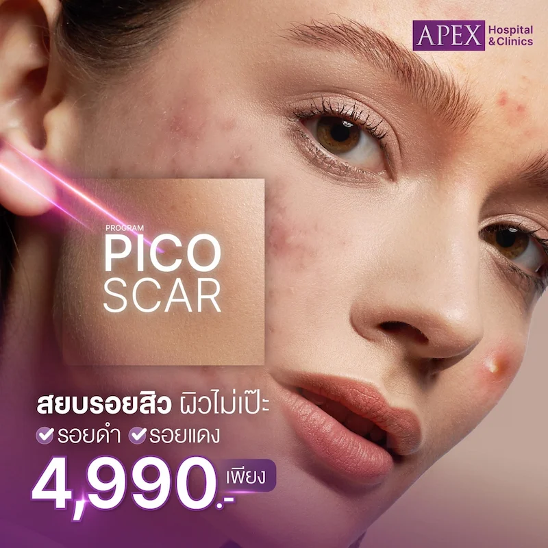 โปรโมชั่น Pico Scar สยบรอยสิว ผิวไม่เป๊ะ เพียง 4,990 บาท