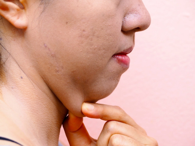 Under Chin Liposuction